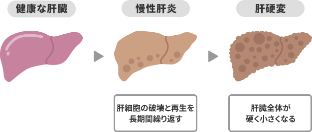 肝硬変の進行の図
            