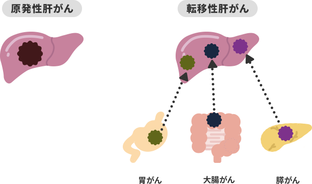 肝がんの分類の図
            
