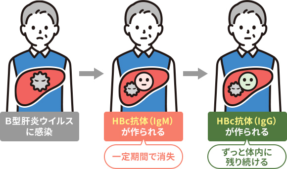 HBc抗体（IgG）とHBc抗体（IgM）の違い